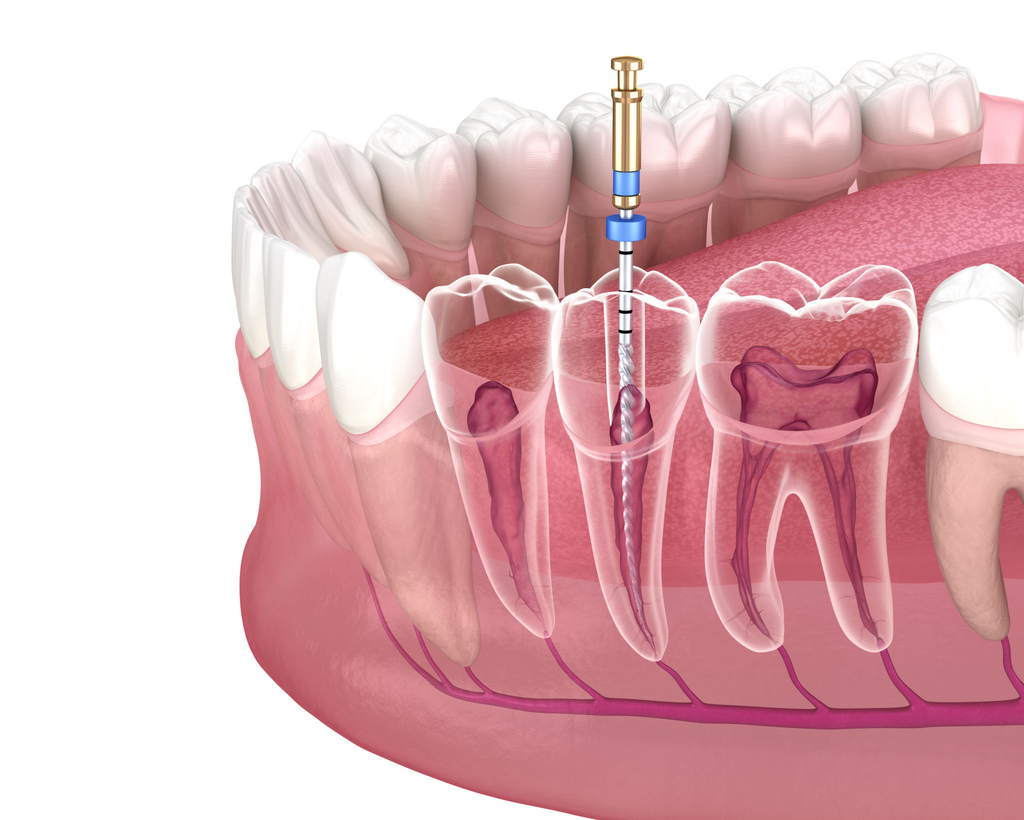 root canal treatment near Millbrae